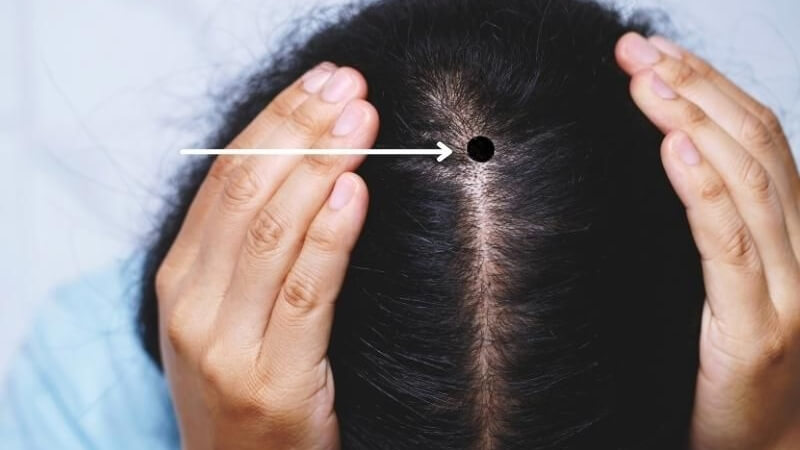 20 vị trí nốt ruồi may mắn của phụ nữ 3 image1 202507090003338929