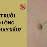 Nốt ruồi có lông là tốt hay xấu? | Tử Vi Cổ Học