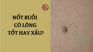 Nốt ruồi có lông là tốt hay xấu? Giải mã ý nghĩa theo quan niệm dân gian và khoa học