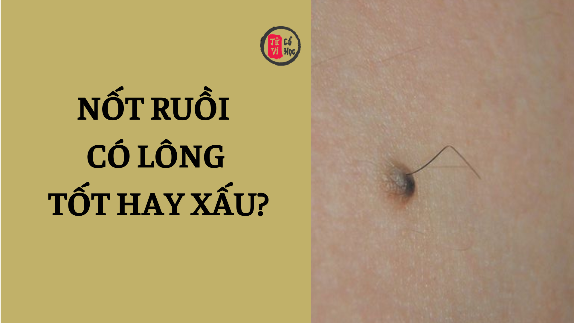 Nốt ruồi có lông là tốt hay xấu? | Tử Vi Cổ Học