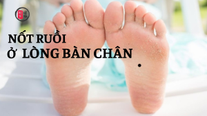 Nốt ruồi ở lòng bàn chân nói lên điều gì?