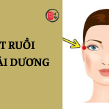 Nốt ruồi ở thái dương có nên xóa hay không? 5 Nốt ruồi ở thái dương có nên xóa hay không? | Tử Vi Cổ Học