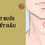 Nốt ruồi ở yết hầu là tốt hay xấu? 3 Nốt ruồi ở yết hầu là tốt hay xấu? | Tử Vi Cổ Học