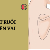 Nốt ruồi trên vai đàn ông và phụ nữ có ý nghĩa gì? | Tử Vi Cổ Học