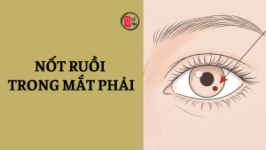 Nốt ruồi trong mắt phải có ý nghĩa gì?